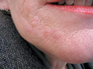 Piel de mentón y región perioral con varias pápulas y nódulos de pequeño tamaño, del color de la piel o levemente eritematosos, algunos apenas visibles y palpables como perdigones bajo la superficie. Es la presentación característica del granuloma por microesferas de polimetilmetacrilato: pequeño, múltiple, en el territorio exacto de la inyección y años después. Cosmetic Medicine and Surgery 2016, figura 56.12.